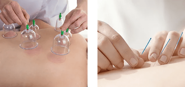 Collage of therapist placing the cup on the back of a female patient and the needle placing on the back of a female