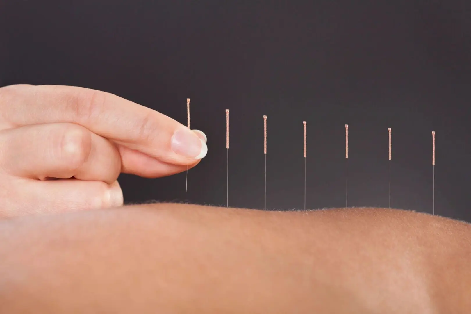 Acupuncture needles inserted into skin.