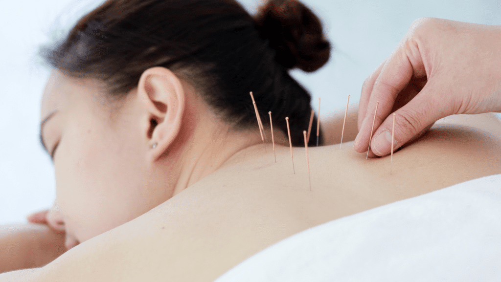 Acupuncture Treatment