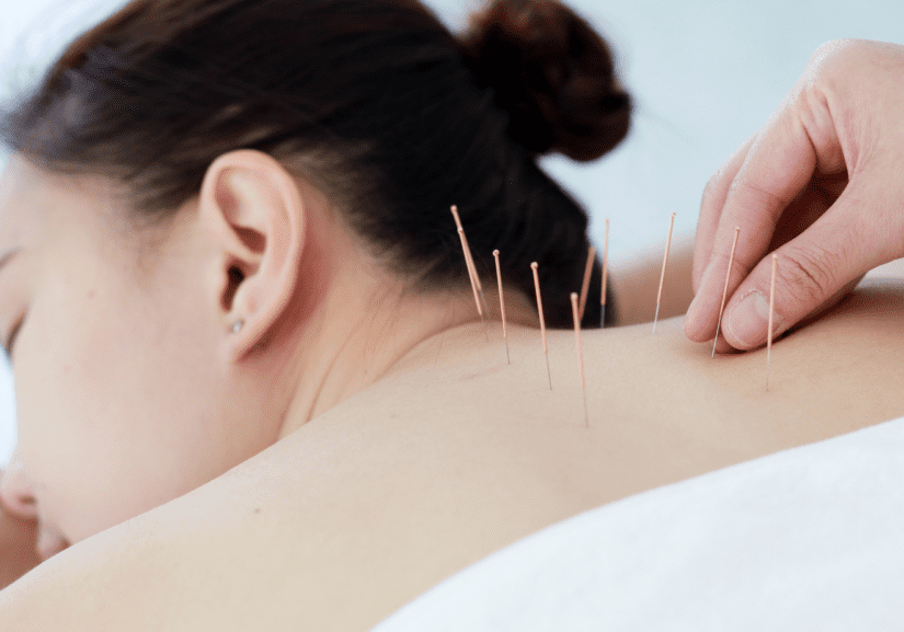 Acupuncture Treatment